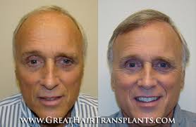 Natural Hair Loss Treatment in Illinois Kane Brookside