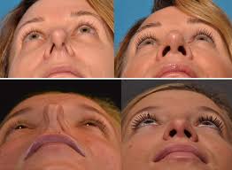 Is Your Nose Bent Out Of Shape Maybe It S A Deviated Nasal Septum Pacific Neuroscience Institute