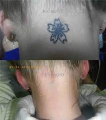 Yes, you may cause cancer if your tattoo does not heal properly. 8 Easy Facts About My 3rd Tattoo Removal Session Pain Cost Scarring Described Darwins Best Businesses Find And Review Local Darwin Businesses