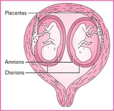 Image result for Multiple Gestation