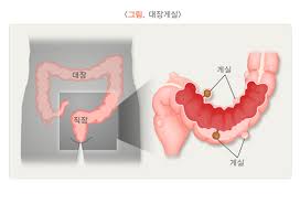 대장게실증 | 국가건강정보포털 | 질병관리청
