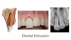 Image result for Tooth Luxation