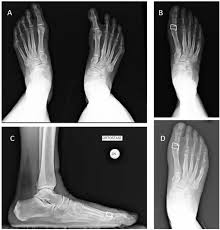 Image result for Hallux Varus