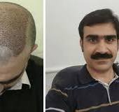 Best Hair Transplant in Islamabad Pakistan | HairnHair