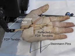 Anatomy of flexor tendon injuries. Quantification Of Partial Or Complete A4 Pulley Release With Fdp Repair In Cadaveric Tendons Journal Of Hand Surgery