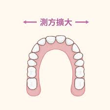 牙齒矯正一定要拔牙齒，才可以有牙齒空間排列出一口整齊的牙齒嗎？