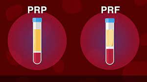 Acs petroleum research fund (acs prf) grants are intended as seed money, to enable an investigator to initiate a new since the first acs prf grants were approved in 1953, several grant. The Future Of Fat Prp Vs Prf Plastic Surgery Hot Topics With Rod J Rohrich Md Youtube