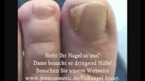 Nagel Probleme Lange Fussnagel Weisse Fussnagel Fussnagel Spray Von Jenn Cosmetic Youtube