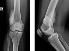 Image result for Osteosarcoma
