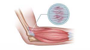 Tennis elbow is also known as lateral epicondylitis, lateral elbow tendinopathy, or extensor tennis elbow symptoms. 3 Simples Exercises To Treat Tennis Elbow Pain From Home Laguna Orthopedic Rehabilitation
