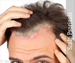 The link between hair thinning and scalp psoriasis. Scalp Psoriasis Frequently Asked Questions Faq S