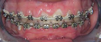 Česta pitanja - vezana uz ortodonciju: terapije, aparati i higijena