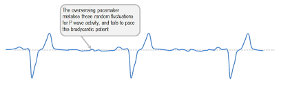 Image result for Transcutaneous Pacing