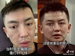 TikTok Star's Plastic Surgery Goes Wrong, Ages Him 20+ Years