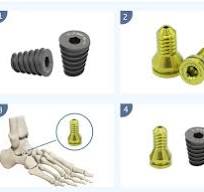 Meditech Orthopedic Implant Subtalar Extra-Articular Screw ...