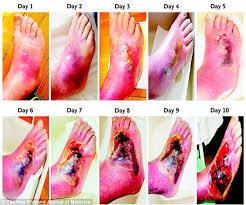 Doctors in 147 specialties are here to answer your questions or offer you advice, prescriptions, and more. The Shocking Images That Reveal What Diabetes Can Do To Your Feet In Just 10 Days Daily Mail Online