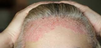 Using the word 'psoriases' in scrabble will fetch you 11 points while using it in words with friends will fetch you 12 points (without taking into consideration the effect of any multipliers). Infusion Therapy Treatment For Psoriasis Infusion Associates