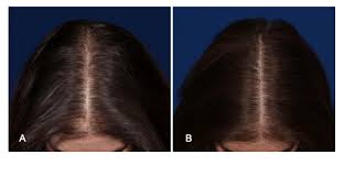 Microneedling for hair loss has shown a lot of promise in recent years and seems to cause. Updates Cures For Hair Loss 2021 Follicle Thought
