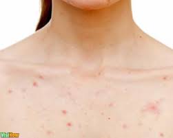 Why do i have blackheads on my breasts? Get Rid Of Blackheads On Your Chest With A Buttermilk Honey And Brown Sugar Scrub Vs Raspberry Puree And Baking Soda Vs Tomato Pulp Garlic Paste And Iodized Salt And 7