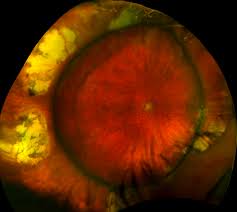 These are particularly clinically useful in eyes with retinal vascular disease. Retinal Detachment Recognizing Pathology Optos