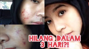 Salep penghilang bekas jerawat dan harganya. Obat Apotik Yang Paling Ampuh Dan Cepat Menghilangkan Bekas Jerawat Pengalaman Pribadi Youtube