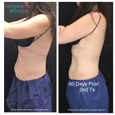 Check spelling or type a new query. Coolsculpting Elite In Grand Rapids Michigan Up To 50 Off Renewal Skin Spa