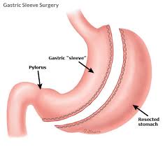 gastric sleeve surgery for weight loss