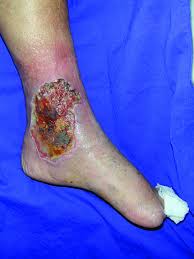Check spelling or type a new query. Systemic Therapies For Leg Ulcers Dissemond 2018 Jddg Journal Der Deutschen Dermatologischen Gesellschaft Wiley Online Library