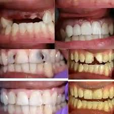 DO YOU HAVE PROBLEMS WITH YOUR TEETH. WE CAN HELP. PLANS FROM R279PM. PLANS  INCLUDES: Visits and examinations, Tooth extraction, Infection control,  Crowns, False teeth and more. FOR MORE INFORMATION PROVIDE YOUR