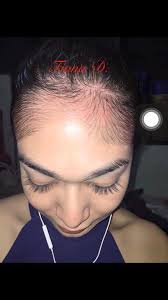 I turning 34 and have a patchy beard. Ginseng Extract Forehead Regrow Hairline Grow Facial Hair Growth Free Ship Buy At The Price Of 13 67 In Aliexpress Com Imall Com
