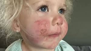 Mum's warning after toddler's face erupted in 'red, angry blisters' in  garden