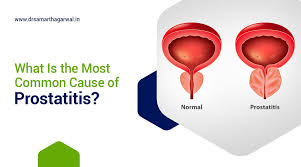 Image result for Chronic Noninfectious Prostatitis