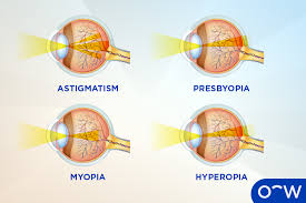 Image result for Refractive Error