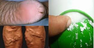 Calo Na Sola Do Pé O Que Fazer Elimina Para Sempre Os Calos E Rachaduras Nos Pes Com Este Incrivel Remedio Caseiro Varizes Rachaduras Nos Pes E Cuidados Com O Corpo