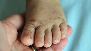 Penyebab gatal pada kulit adalah kulit kering, penyakit kulit, alergi, hingga penyakit sistemik. Cara Tepat Mengatasi Suleten Atau Impetigo Pada Bayi