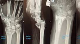 Incidence of Flexor Tendon Injuries in Complex Intra ...