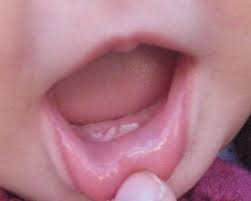El Cuidado De Los Primeros Dientes