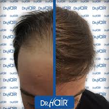 Dr Hair Hair Transplantation Turkey Dhi Choi Pens Sac