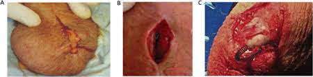 Maybe you would like to learn more about one of these? Penile Implant Infection Part 3 The Changing Spectrum Of Treatment International Journal Of Impotence Research