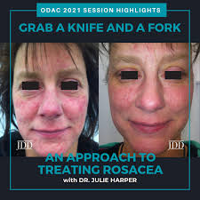 Image result for demodex rosacea