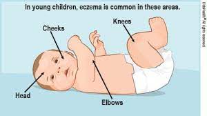 Eczema Atopic Dermatitis For Parents Nemours Kidshealth