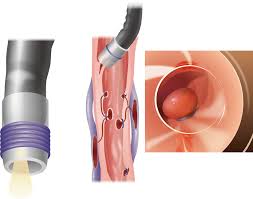 Endoscopic variceal ligation
