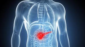 Pancreatic cancer may be difficult to detect at an early stage and it is often diagnosed in more advanced stages. Ireland Ranks Fourth Out Of 30 Countries For Pancreatic Cancer Treatment