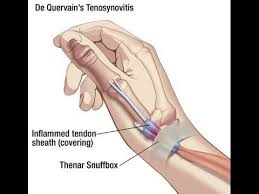 De Quervain S Tenosynovitis Youtube