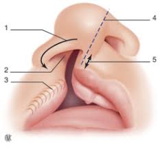 Por lo general, el labio leporino y paladar hendido se detectan en el nacimiento, y el médico puede comenzar a coordinar la atención médica en ese momento. Tratamiento Primario Del Labio Leporino Y Del Paladar Hendido Sciencedirect