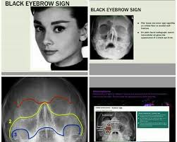 Black Eyebrow Sign Black Eyebrow Sign Is The Description Given On Plain Facial Radiographs To Intra Orbital Air Air Rises Black Eyebrows Radiology Air Leaks