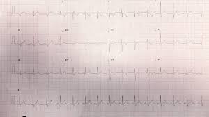 In serious cases, the signs and symptoms of myocarditis vary, depending on the cause of the disease. Myocarditis Resus