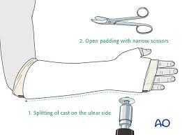 Image result for Short Arm Cast