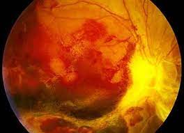 Healthy people 2020 sets national objectives to improve eye health and uses data to track progress toward these goals. Covid 19 Impact On Diabetic Retinopathy Market Value To Register 2 4 Billion Growth By 2022 Medgadget