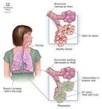 Image result for icd 10 code for acute aspiration pneumonia